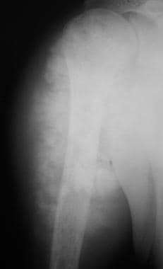Osteosarcoma. Anteroposterior (AP) radiograph in a