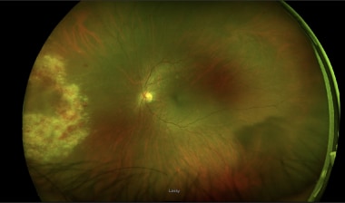 cytomegalovirus retinitis statistics