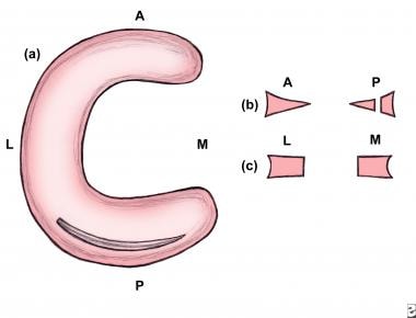 Axial illustration of a full-thickness longitudina