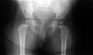 Frontal radiograph of the pelvis. The ossification