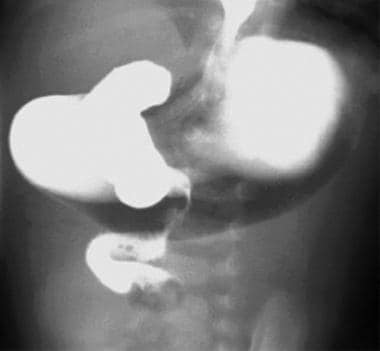 Upper GI series shows malrotation with midgut volv