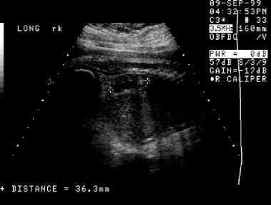 A second prenatal sonogram (same patient as in the