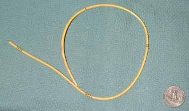 Retrieved catheter fragment (same patient as in th