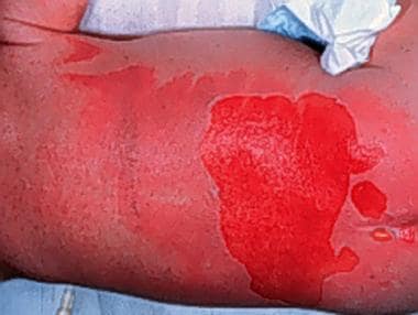 Burn wound cellulitis presents with increasing ery
