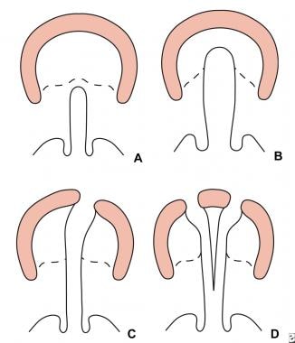 Veau classification of cleft lip and palate. A: Gr