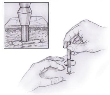 Illustration of punch biopsy being performed. 