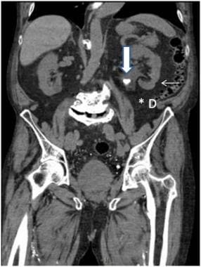 CT of the abdomen and pelvis without contrast; a r