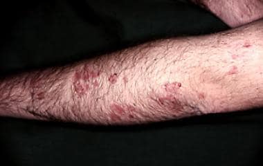 dermatitis herpetiformis palms