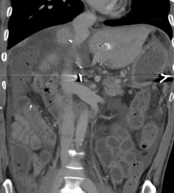 C-2: Gortex hepatic artery graft thrombosis in a 5