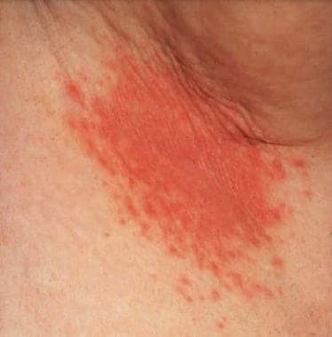 Erythema, maceration, and satellite pustules in th