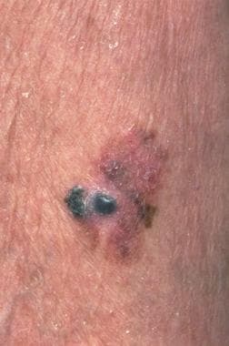 Malignant melanoma. Courtesy of Hon Pak, MD. 