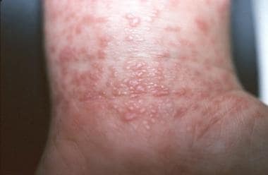 vesicular lichen planus