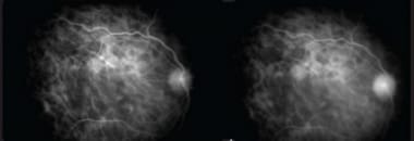 Indocyanine green angiography: Early phase (left) 