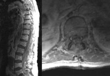 spinal epidural hematoma