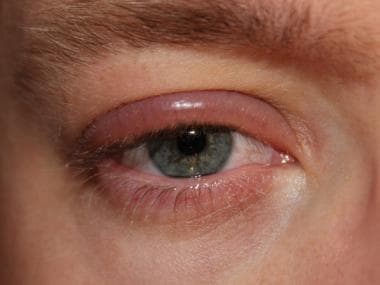 Blepharitis. Venligst udlånt af