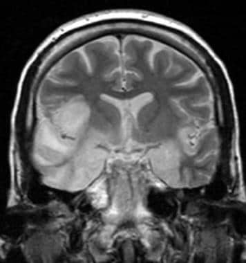 HSV encephalitis; coronal T2-weighted MRI showing 