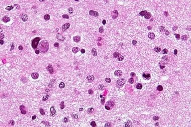 Higher-grade IDH-mutant astrocytoma, with nuclear 