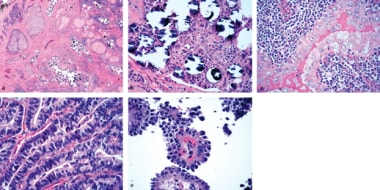 Variants of papillary thyroid carcinoma. (top left