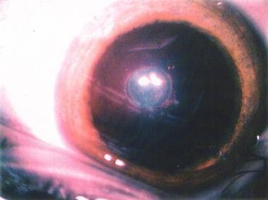 The posterior polar cataract is seen as a dense di