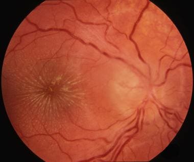 Neuroretinitis in the right eye of an adolescent w