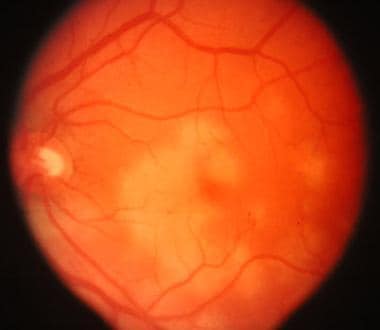 Acute Posterior Multifocal Placoid Pigment Epitheliopathy ...