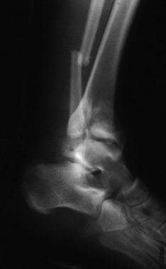 Lateral radiograph of pilon fracture. 