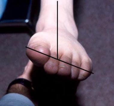 Pes Planus (Flatfoot) Clinical Presentation: History, Physical Examination