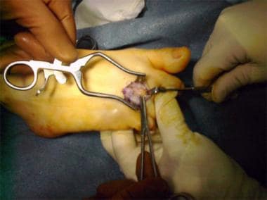 Surgery for Morton neuroma. Superficial exposure. 