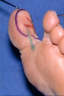 Markings for a free tissue transfer of great toe p