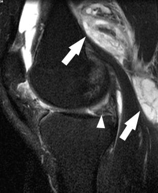 Baker cyst. Sagittal T2-weighted magnetic resonanc