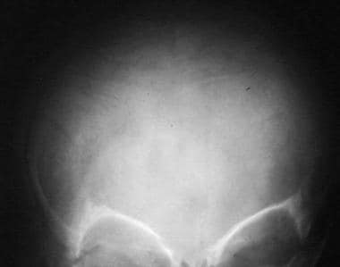 Osteogenesis imperfecta. Wormian bones are present