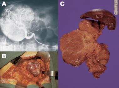 Patient with a large VIPoma. (A) Arteriogram showi