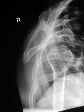 Y-view radiograph of right shoulder shows anterior