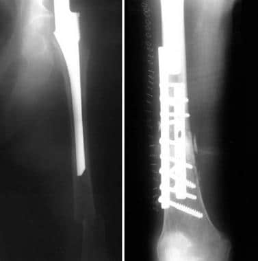 Distal femur fracture during hip arthroplasty. 