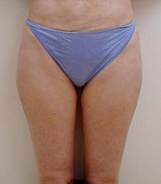 Liposuction, trunk. Frontal view 3 months after 3 