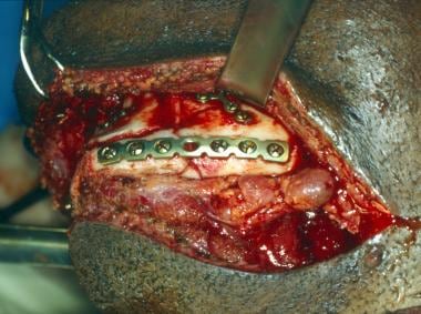 Mandibular fracture. Left lateral view. 
