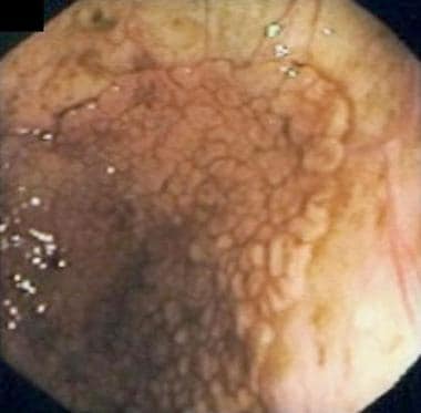 Villous Adenoma. Endoscopic view of a sessile poly