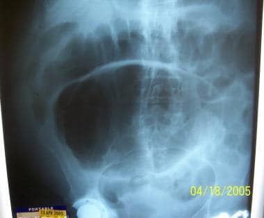Intestinal Motility Disorders. This radiograph rev