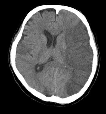 Vascular distributions: Middle cerebral artery (MC