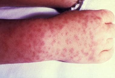 The patient's rash is a major diagnostic sign of R