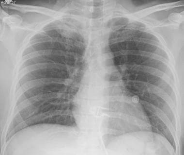 This chest radiograph shows asymmetry in the first