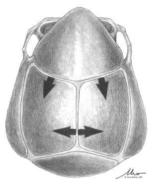 Metopic craniosynostosis (trigonocephaly).