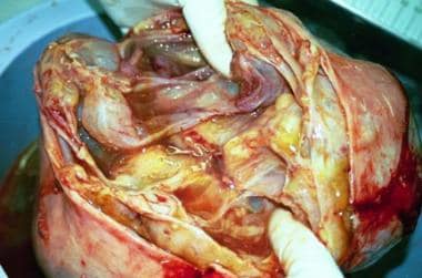 An ovarian cyst is a fluid-filled sac that forms on or within an