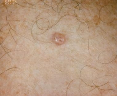 Skin cancer benign mole - Warts and skin cancer - Multiple basal cell papillomas