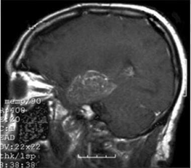 A T1-weighted sagittal MRI with intravenous contra