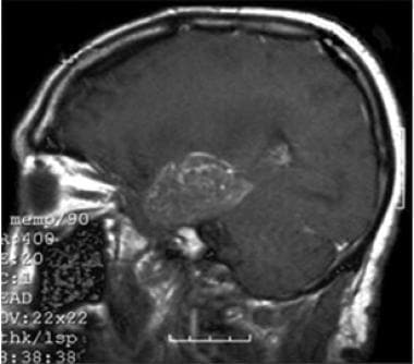 具有静脉注射的T1加权矢状MRI