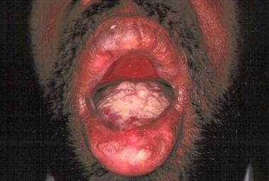 Oral aphthous ulcers secondary to Behçet disease. 