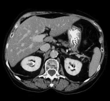 CT scan demonstrating right renal pelvis upper tra