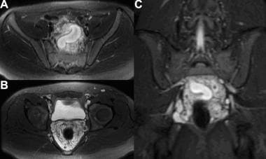 直肠动静脉畸形(AVM)的MRI。