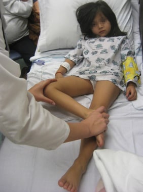 little girls in frog position Medical examination Pediatric Limp Clinical Presentation: History, Physical Examination